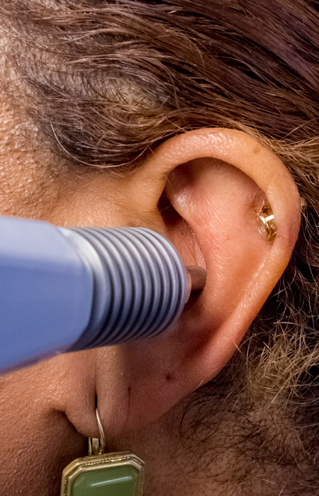 German Auricular Acupuncture in Vancouver