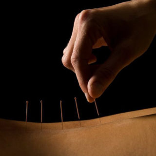 Acupuncture for Pain Management in Vancouver